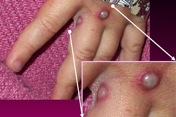 FOLLOW THIS GUIDELINES FOR MONKEYPOX DISEASE !